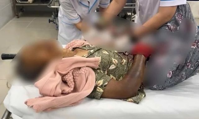 Tin lời chữa rắn cắn theo mẹo dân gian, người phụ nữ 76 tuổi nguy kịch: Sai lầm tai hại!