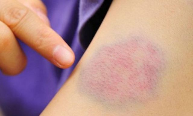 5 dấu hiệu nhỏ trên da 