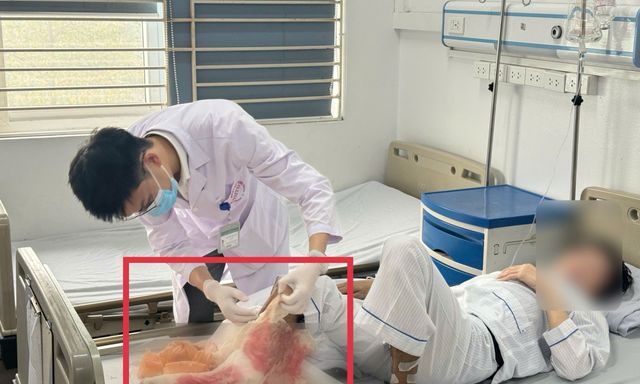 Đắp lá chữa bỏng suốt 1 tháng theo kinh nghiệm dân gian, người đàn ông suýt mất chân vì hoại tử lan đến xương