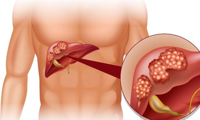 Cảnh báo từ WHO: 1 loại ĐỘC TỐ gây ung thư ẩn trong nhiều thực phẩm quen thuộc mà người Việt ĂN MỖI NGÀY