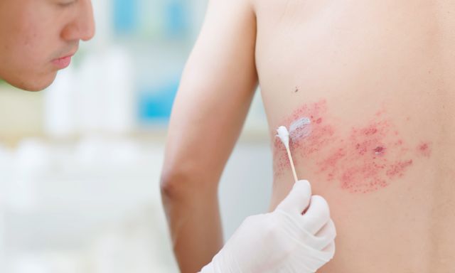 Chuyên gia cảnh báo: Hơn 90% người Việt Nam trưởng thành mang sẵn virus này, cứ 3 người thì có 1 người phát bệnh