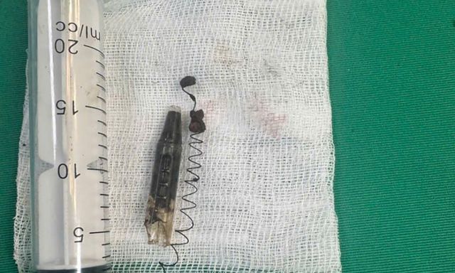 13 năm bị găm đầu bút bi ở vùng thái dương chỉ vì một lần nô đùa: Bác sĩ cảnh báo không thể chủ quan với vết thương nhỏ