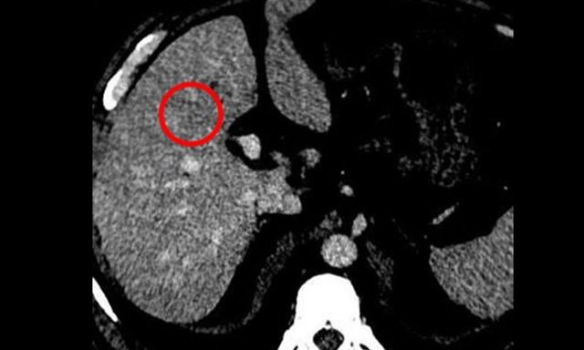 Tưởng đã kiểm soát viêm gan B, người đàn ông nhận ‘án’ UNG THƯ vì thói quen nhiều người mắc