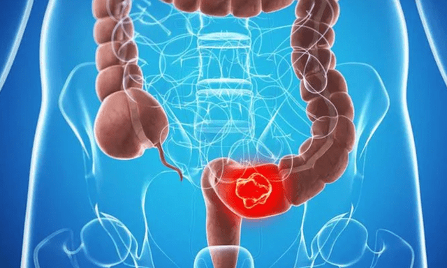 Người đàn ông 45 tuổi tử vong sau vài tháng phát hiện ung thư đại trực tràng: “Thủ phạm” là 3 ĐIỀU người Việt nào cũng hiểu nhưng LƯỜI LÀM
