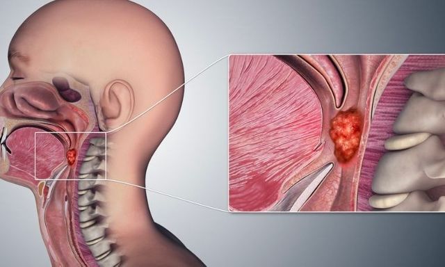 Nghẹt mũi tưởng viêm xoang, sau 3 tháng người đàn ông 33 tuổi phát hiện mắc ung thư giai đoạn cuối: 3 dấu hiệu quen thuộc khiến nhiều người chủ quan!