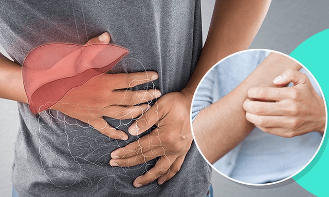 Không phải dị ứng: 2 DẤU HIỆU cơ thể đang “kêu cứu” vì ung thư gan, nhiều người Việt vẫn chủ quan