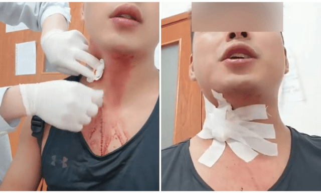 Khó tin: Nhập viện do vỡ tĩnh mạch sau khi cố đập... muỗi