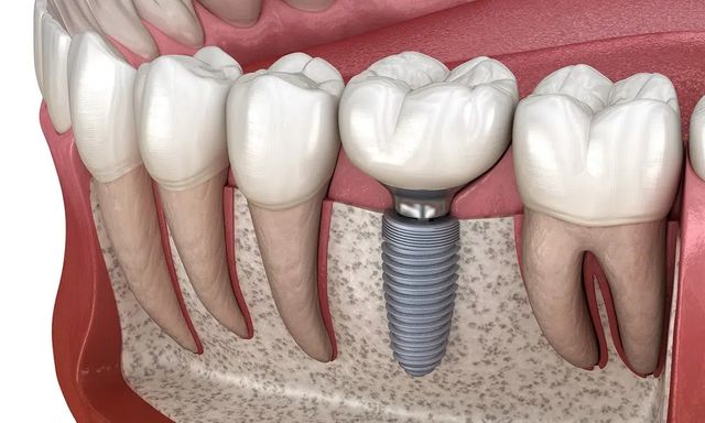 Mách bạn địa chỉ trồng răng chất lượng cao tại Nghệ An