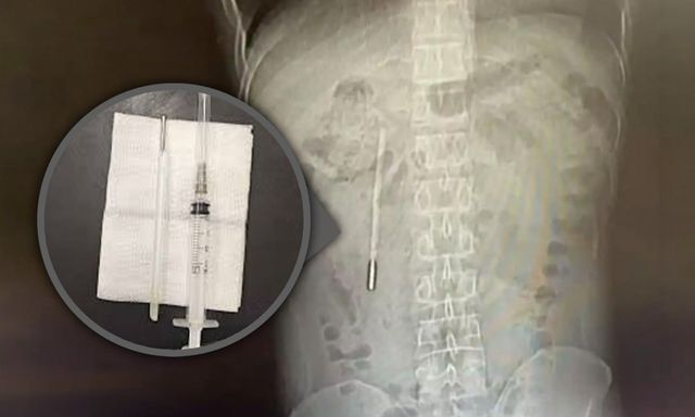 Đi viện vì đau dạ dày, người đàn ông bất ngờ phát hiện chiếc nhiệt kế thủy ngân nằm trong bụng suốt hai mươi năm