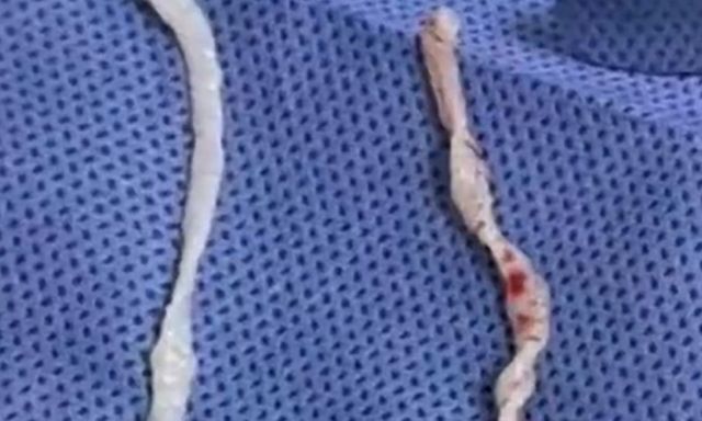 Đau cánh tay suốt một năm, người phụ nữ bàng hoàng khi bác sĩ phát hiện hai sinh vật dài 10cm đang sống dưới da