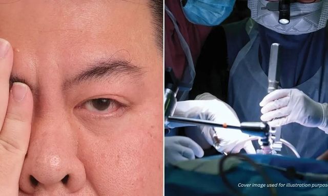 Tin vào mẹo dân gian trên mạng để giải xui khi nháy mắt phải, người đàn ông suýt mù vĩnh viễn vì bị bong võng mạc