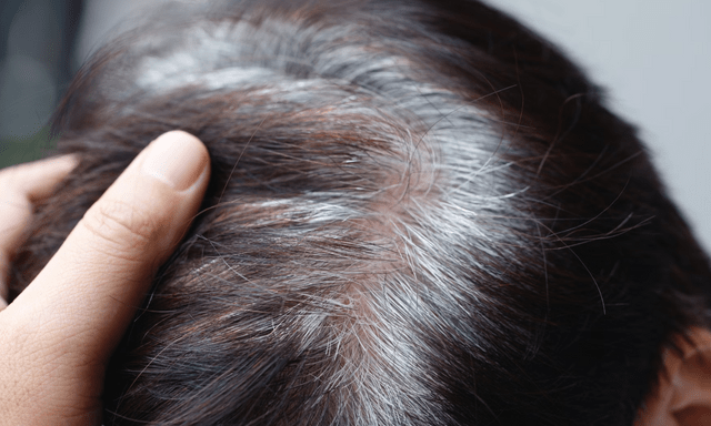 Bác sĩ nói gì về tin “tóc bạc nhiều là dấu hiệu ung thư”?