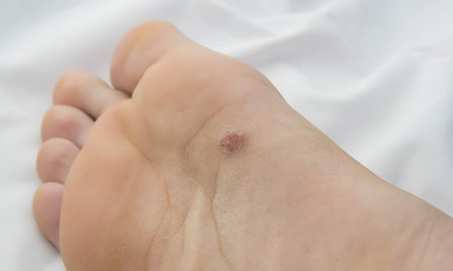 Có dấu hiệu lạ ở lòng bàn chân, người đàn ông làm ngay 1 việc: Được bác sĩ khen vì phát hiện ung thư sớm