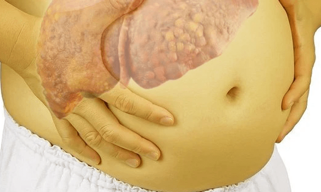 Nhiều người Việt xơ gan, ung thư gan chỉ vì dùng 1 thứ tưởng 