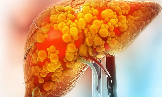 5 “thủ phạm” khiến gan ngập trong mỡ: Ít ai ngờ tới