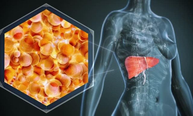 1 bệnh về gan “bùng lên”, người trẻ cũng không còn an toàn: Bác sĩ chỉ ra xu hướng điều trị mới
