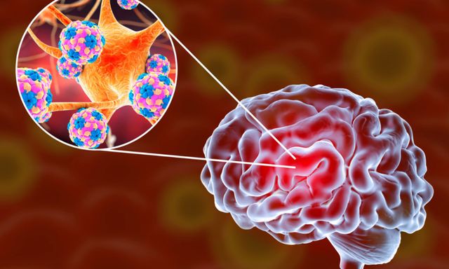 Người phụ nữ viêm màng não nguy kịch tính mạng: Bác sĩ nói thẳng thủ phạm đến từ môi trường sống