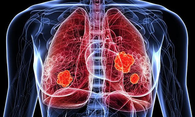 Con số đáng lo ngại về ung thư phổi tại Việt Nam