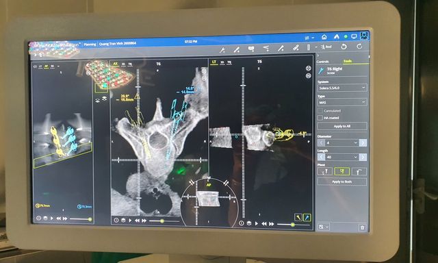 Chàng sinh viên cao 1m86 bị biến dạng toàn bộ cột sống vì một lý do: Bác sĩ cảnh báo người trẻ