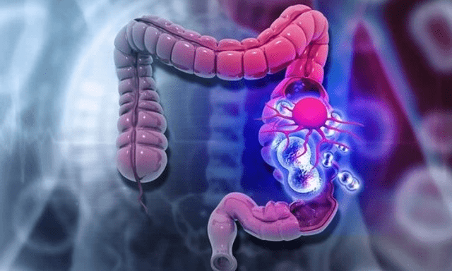 Ung thư đại trực tràng ở người trẻ ngày càng gia tăng, 