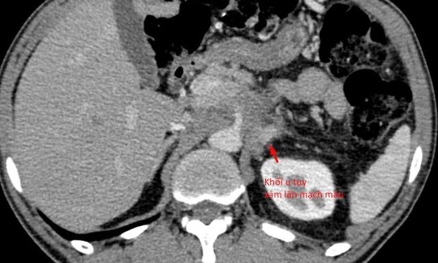 21 ngày 'bỏ đói' cơ thể, người đàn ông Hà Nội nhận kết quả khiến bác sĩ cảnh báo khẩn