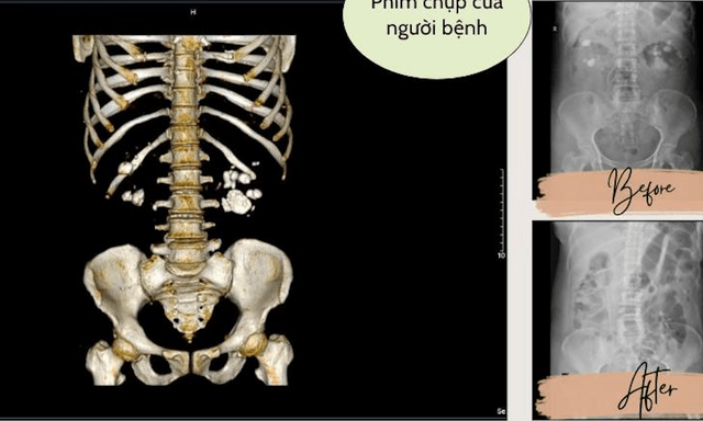 Xem phim chụp CT, bác sĩ “tá hỏa” khi thấy điều không ai ngờ trong thận người bệnh