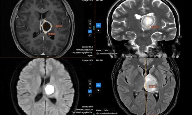Thường xuyên buồn ngủ, đi khám “sốc” nặng khi biết nguyên nhân