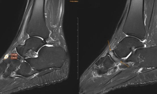 4 thói quen âm thầm “ăn mòn” xương ở người trên 40 tuổi
