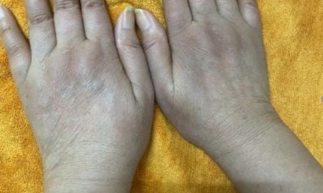 Nữ doanh nhân có 1 dấu hiệu lạ ở tay nhiều năm: Đi khám bác sĩ cảnh báo hàng loạt tạng đang 