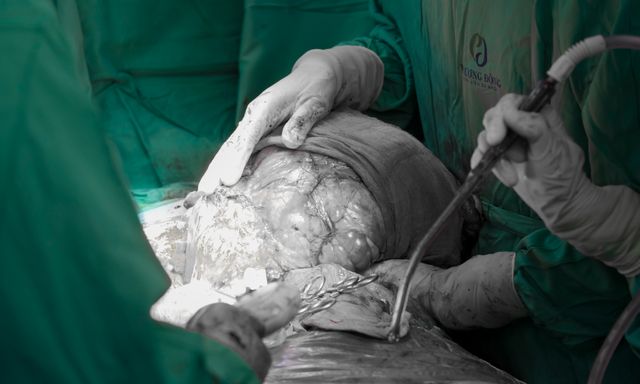 Bụng to như mang thai 9 tháng, người phụ nữ phát hiện thứ khủng khiếp bên trong