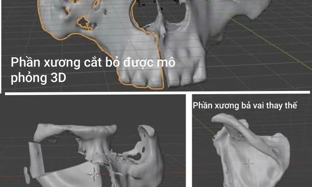 Chỉ trong 3 tháng, người đàn ông Hà Nội bị “ăn mòn” một phần mặt: Nguyên nhân do đâu?