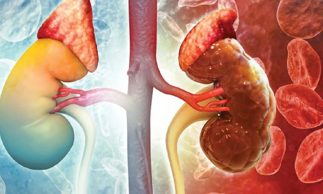 Cảnh báo 'mắt xích' hàng đầu âm thầm gây suy thận: Thật may vì có 3 thói quen 'cứu cánh'