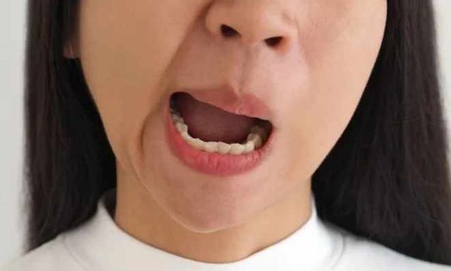Cảnh báo bệnh liệt mặt 