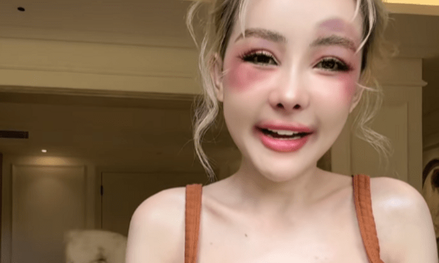 Nữ hoàng thẩm mỹ Ngân 98 gặp sự cố đau đớn, hé lộ về lần phẫu thuật tiếp theo