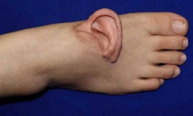 Nối lại tai đã đứt rời sau khi nuôi ở bàn chân suốt 5 năm tháng