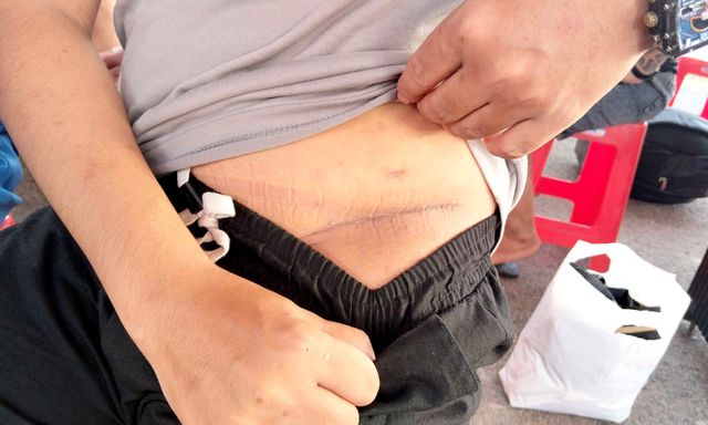 Nam thanh niên sang Campuchia làm “việc nhẹ lương cao” bị cưỡng ép cắt bỏ một quả thận: Vết sẹo dài bên mạn sườn gây ám ảnh