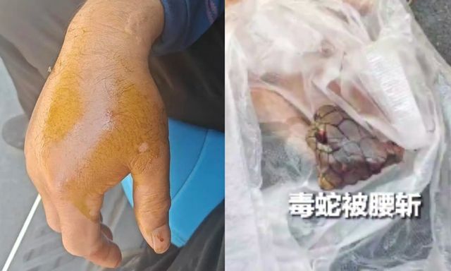 Bị rắn hổ mang chúa dài 2 mét cắn, người đàn ông chém đứt xác rắn rồi đến bệnh viện