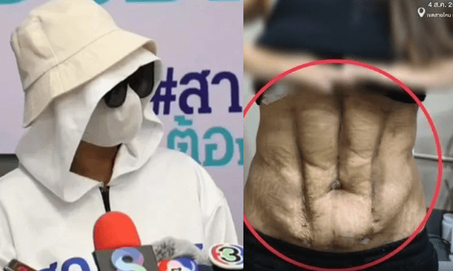 Phần bụng biến dạng của người phụ nữ sau ca phẫu thuật 