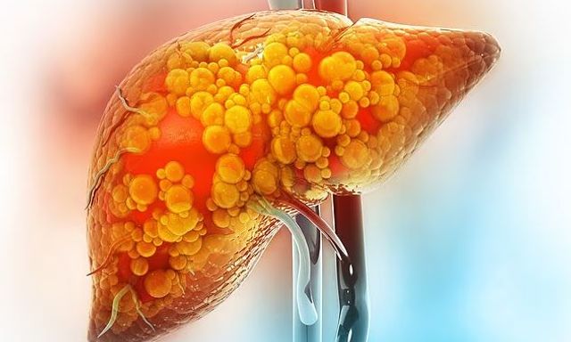 Không uống một giọt rượu nào vẫn mắc bệnh gan: ‘Thủ phạm’ là 1 thói quen cực xấu!