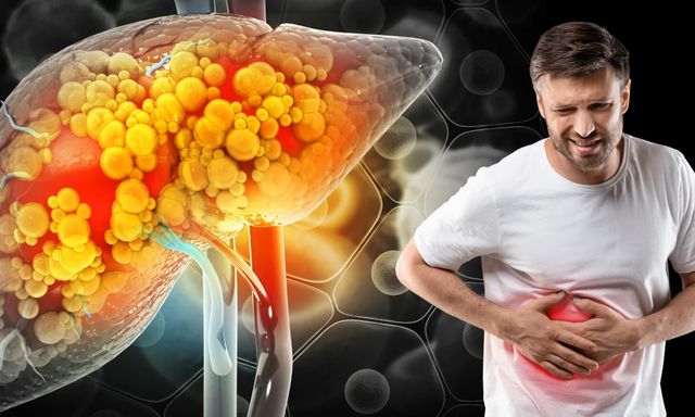 Nghiên cứu khoa học chỉ rõ 1 việc giúp đảo ngược tình trạng gan nhiễm mỡ: Muốn bảo vệ gan, hãy làm ngay