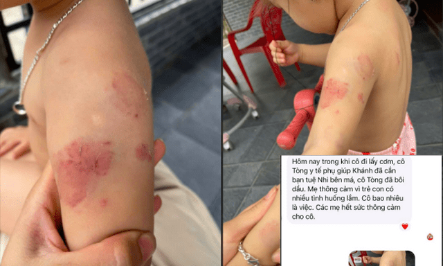 Bé hơn 2 tuổi có nhiều vết cắn, bầm tím: Giáo viên nói 