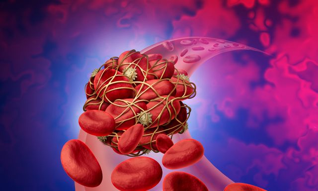 Cục máu đông rất 