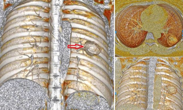 Xét nghiệm có chỉ số mang thai, cô gái ngỡ ngàng khi “thủ phạm” là ung thư tạo triệu chứng đánh lừa