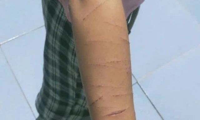 Bé gái đến trường với nhiều vết thương trên người, giáo viên liền báo công an: Bất ngờ người gây chuyện