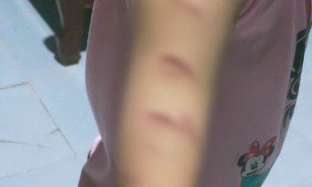 Vụ bé gái bị chị họ 12 tuổi dùng dao rạch khắp người: Mâu thuẫn từ việc em giật áo chị rủ chơi cùng