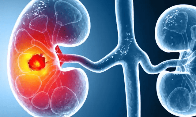 Số ca mắc ung thư thận gia tăng trên toàn cầu: Ở giai đoạn sớm hay muộn đều có 3 dấu hiệu này
