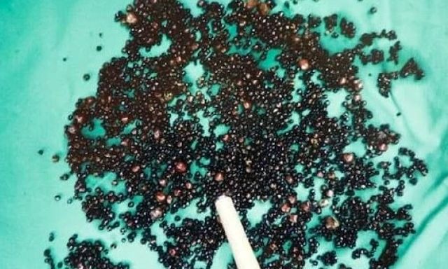 5000 viên sỏi lấp kín túi mật người đàn ông: Bác sĩ nói thẳng: 