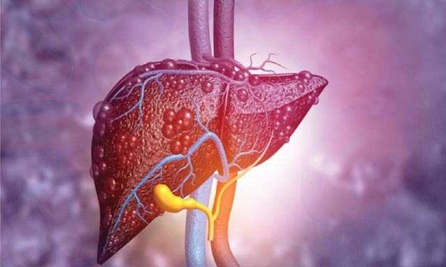 Có 1 dấu hiệu kéo dài suốt 3 tháng, người đàn ông đi khám phát hiện gan “dày đặc khối u” 