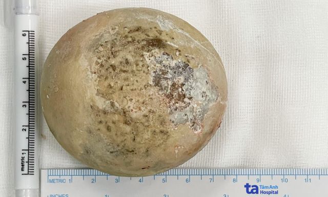 Người đàn ông có sỏi to bằng nắm tay: Mổ xong phát hiện thêm điều khủng khiếp