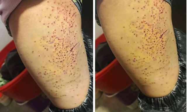 Nữ sinh lớp 7 dùng bút bi đâm hơn 20 lần lần vào đùi bạn học: Đây là nguyên nhân